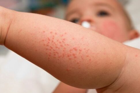 Allergie bei einem Kind als Symptom für das Vorhandensein von Würmern.
