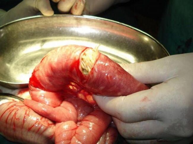 Ches-Parasiten sind gefährlich für den Menschen.